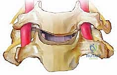 صورة توضيحية لـ عملية استئصال القرص العنقي الأمامي ودمج الفقرات (ACDF) دليل شامل من الأستاذ الدكتور محمد هطيف
