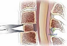 صورة توضيحية لـ عملية استئصال القرص العنقي الأمامي ودمج الفقرات (ACDF) دليل شامل من الأستاذ الدكتور محمد هطيف