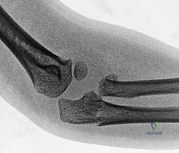 صورة طبية: كسور رأس وعنق الكعبرة: دليل شامل للتشخيص والعلاج والتعافي في صنعاء مع الأستاذ الدكتور محمد هطيف