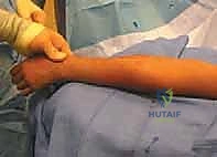 صورة توضيحية لـ كسور رأس وعنق الكعبرة: دليل شامل للتشخيص والعلاج والتعافي في صنعاء مع الأستاذ الدكتور محمد هطيف