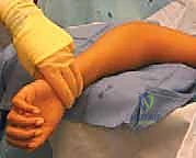 صورة توضيحية لـ كسور رأس وعنق الكعبرة: دليل شامل للتشخيص والعلاج والتعافي في صنعاء مع الأستاذ الدكتور محمد هطيف