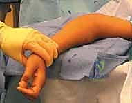 كسور رأس وعنق الكعبرة: دليل شامل للتشخيص والعلاج والتعافي في صنعاء مع الأستاذ الدكتور محمد هطيف