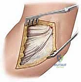 تطبيق الجبيرة الطبية في حالات العلاج التحفظي