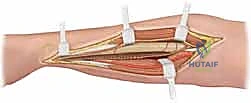 Illustration of osteotomy for radius - Dr. Mohammed Hutaif