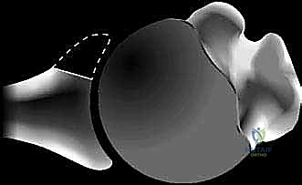 فقدان العظم الأمامي للتجويف الحقاني