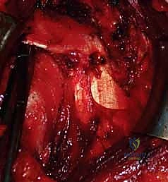 تأثير فقدان العظم على استقرار المفصل