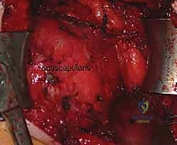 الأشعة المقطعية ثلاثية الأبعاد لتقييم الكتف