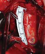 أخذ الطعم العظمي من الحوض