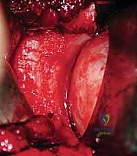 تحديد مكان الترقيع العظمي