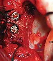 صورة توضيحية لـ ترميم التجويف الحقاني للكتف بترقيع عظمي ذاتي: حل جذري لعدم استقرار الكتف المتكرر في صنعاء