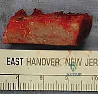 تشكيل الطعم العظمي ليناسب التجويف الحقاني