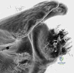 Illustration of anterior shoulder instability - Dr. Mohammed Hutaif