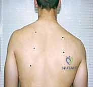 Illustration of management of shoulder - Dr. Mohammed Hutaif