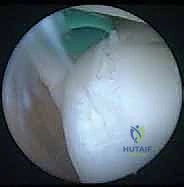أعراض النقرس