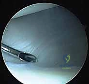 Arthroscopic Management of Shoulder Throwing Injuries: A Masterclass in Glenohumeral Biomechanics and Repair