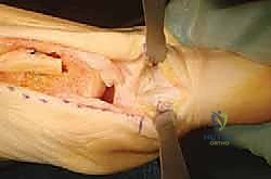 صورة توضيحية لعملية قطع عظم أكين لتصحيح إبهام القدم الأروح