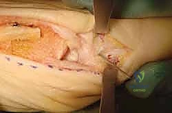 تشريح إبهام القدم الأروح بين السلاميات