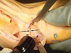 صورة توضيحية لـ قطع عظم أكين: الحل الدقيق لإبهام القدم الأروح بين السلاميات على يد الأستاذ الدكتور محمد هطيف