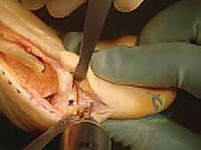 قطع عظم أكين: الحل الدقيق لإبهام القدم الأروح بين السلاميات على يد الأستاذ الدكتور محمد هطيف