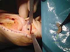 إزالة الإسفين العظمي بدقة متناهية