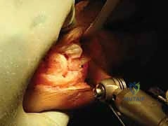 مبدأ عمل عملية قطع عظم أكين الجراحية