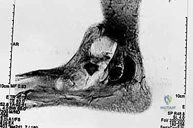 التهاب الأعصاب الالتصاقي: الأسباب، الأعراض، والعلاج المتقدم في صنعاء مع الأستاذ الدكتور محمد هطيف