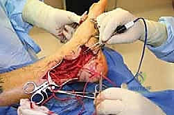 فهم التندب العصبي والالتصاقات في الأنسجة الرخوة