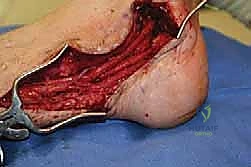 التشريح الدقيق للعصب الظنبوبي الخلفي في الكاحل