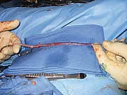 تقييم أعراض وعلامات انضغاط العصب اللاصق