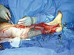 صورة توضيحية لـ التهاب الأعصاب الالتصاقي: الأسباب، الأعراض، والعلاج المتقدم في صنعاء مع الأستاذ الدكتور محمد هطيف