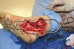 صورة توضيحية لـ التهاب الأعصاب الالتصاقي: الأسباب، الأعراض، والعلاج المتقدم في صنعاء مع الأستاذ الدكتور محمد هطيف