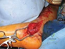 صورة توضيحية لـ التهاب الأعصاب الالتصاقي: الأسباب، الأعراض، والعلاج المتقدم في صنعاء مع الأستاذ الدكتور محمد هطيف