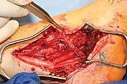 صورة توضيحية لـ التهاب الأعصاب الالتصاقي: الأسباب، الأعراض، والعلاج المتقدم في صنعاء مع الأستاذ الدكتور محمد هطيف