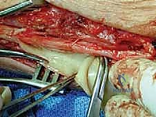 Revision Nerve Decompression and Barrier Procedures for Adhesive Neuralgia