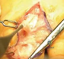 Surgical technique step for Flexor and Extensor Tenosynovectomy