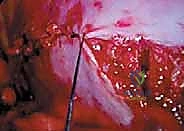 Proximal Humerus Fractures: Epidemiology, Etiology, Diagnosis, and Treatment