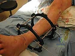 الأستاذ الدكتور محمد هطيف أثناء تقييم حالة كاحل