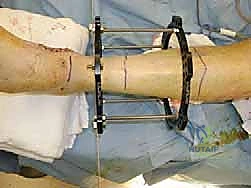 جهاز إليزاروف لتشتيت الكاحل