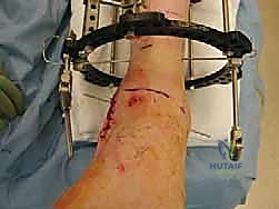 تقييم استقامة الطرف السفلي