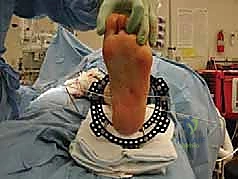 إدخال الأسلاك بدقة جراحية