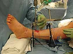 تشريح غضروف الكاحل