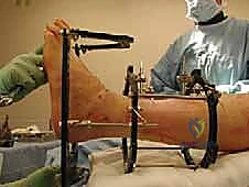 صورة توضيحية لـ تشتيت مفصل الكاحل: حل بيولوجي متقدم لتجديد الغضروف وتخفيف الألم مع الأستاذ الدكتور محمد هطيف