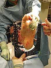 صورة طبية: تشتيت مفصل الكاحل: حل بيولوجي متقدم لتجديد الغضروف وتخفيف الألم مع الأستاذ الدكتور محمد هطيف