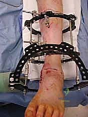 التخطيط الجراحي على الكمبيوتر