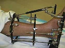 صورة طبية: تشتيت مفصل الكاحل: حل بيولوجي متقدم لتجديد الغضروف وتخفيف الألم مع الأستاذ الدكتور محمد هطيف