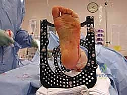 صورة طبية: تشتيت مفصل الكاحل: حل بيولوجي متقدم لتجديد الغضروف وتخفيف الألم مع الأستاذ الدكتور محمد هطيف