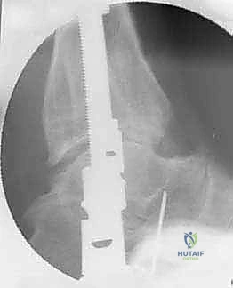 صورة طبية: تشتيت مفصل الكاحل: حل بيولوجي متقدم لتجديد الغضروف وتخفيف الألم مع الأستاذ الدكتور محمد هطيف