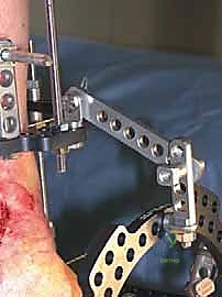 استخدام المنظار الجراحي في الكاحل