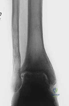 عملية إزالة الإطار الخارجي