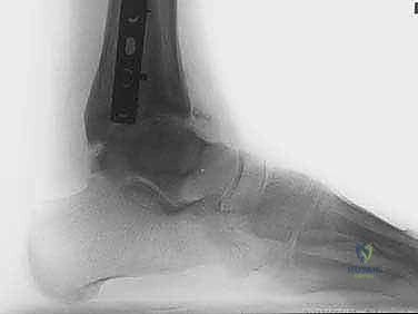 صورة توضيحية لـ تشتيت مفصل الكاحل: حل بيولوجي متقدم لتجديد الغضروف وتخفيف الألم مع الأستاذ الدكتور محمد هطيف